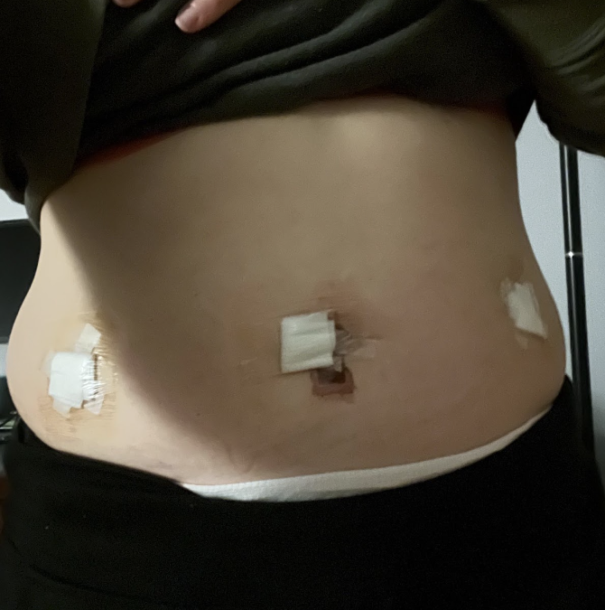 My Experience with Arthroscopic Abdominal Surgery